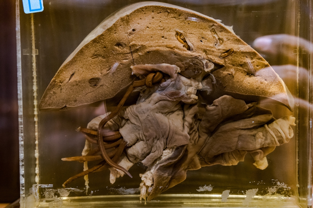 268610 Ascaris lumbricoides infestation in a child's liver. This worm is the most common found in humans. This is one of the rarest pieces. — Picture by Firdaus Latif