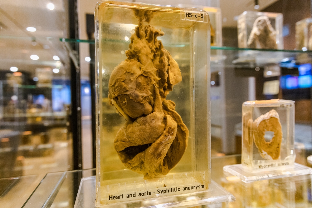 268611 A heart infested with syphilis causing aneurysms in the aorta. — Picture by Firdaus Latif